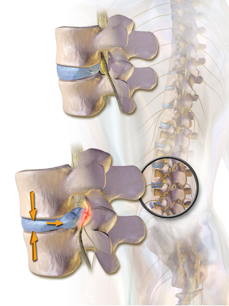 Contrast the herniated lumbar disc impinging upon the spinal nerve, at bottom, with the healthy disc, at top