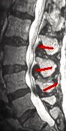 Lumbar_Spinal_Stenosis