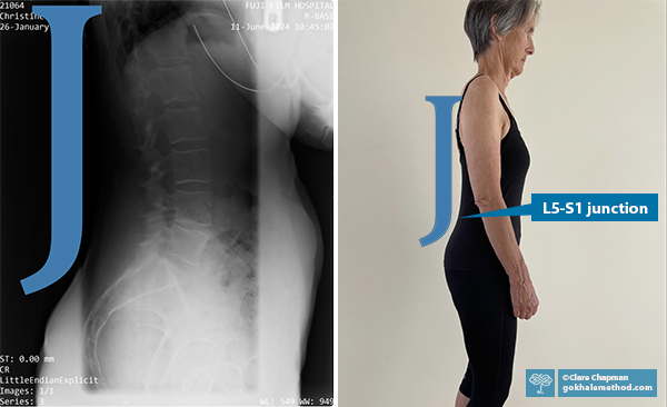 X-ray of Christine’s J-spine (left) and photo of her standing side on (right).