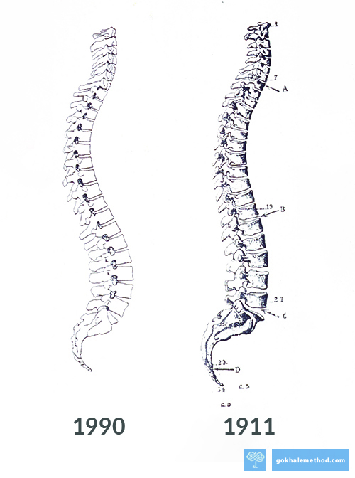 An S-shaped spine medical illustration from 1990, and a J-shape spine from 1911.