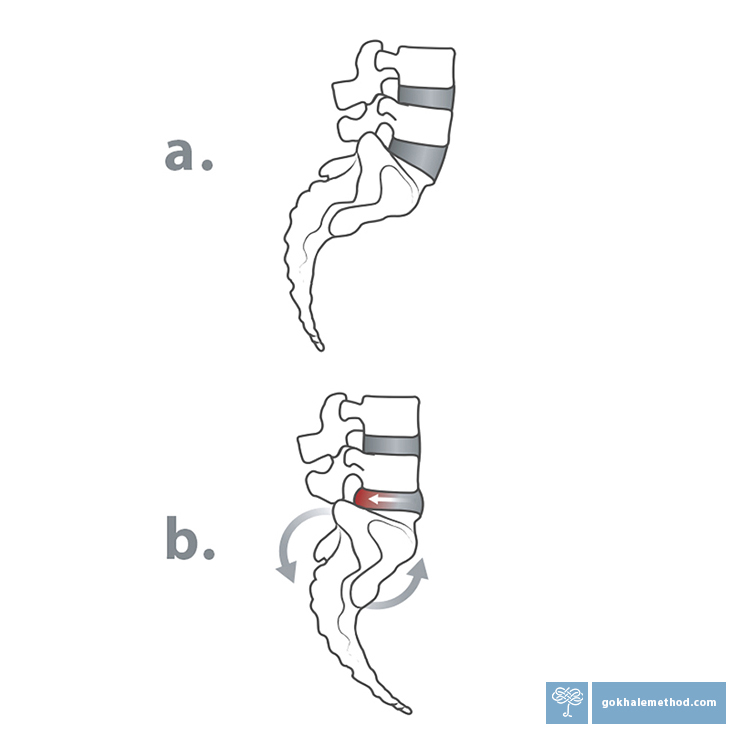 Diagrams showing the lower lumbar vertebrae and sacrum, (a.) anteverted at L5-S1, (b.) retroverted (tucked) at L5-S1.