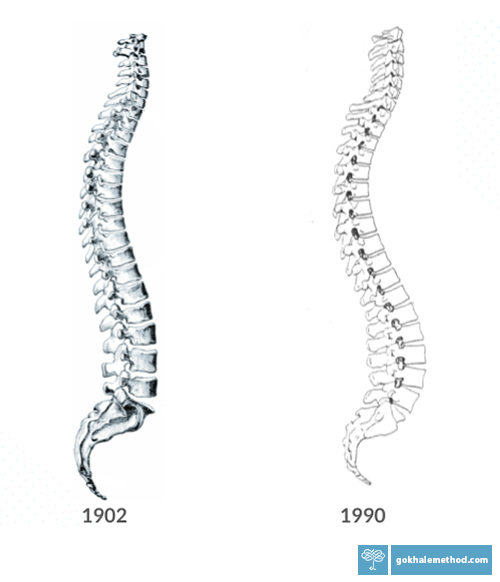 Two medical illustrations of the spine: 1902 J-spine and 1990 S-spine.