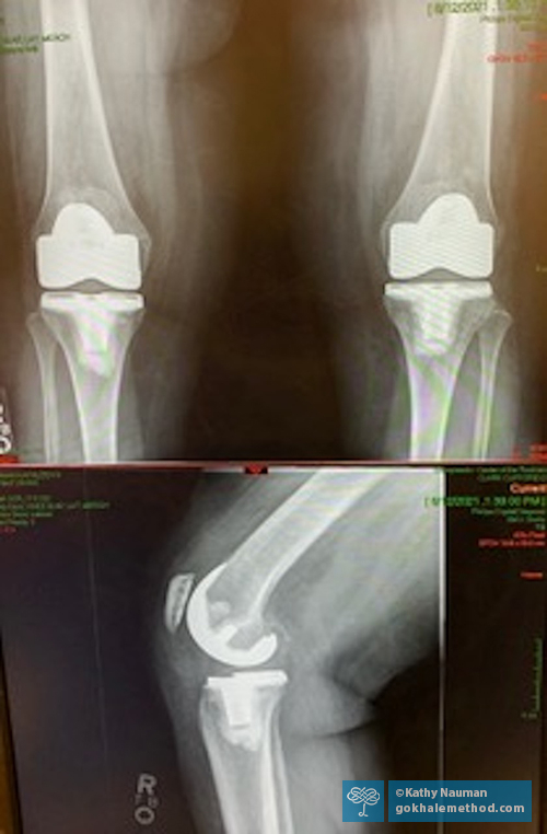 Gokhale Method Alumna Kathy Nauman’s post knee replacement X-rays.