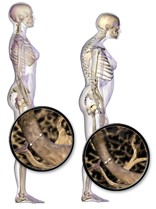 Drawing of effect of osteoporosis on the thoracic and cervical spine and bone close-up.