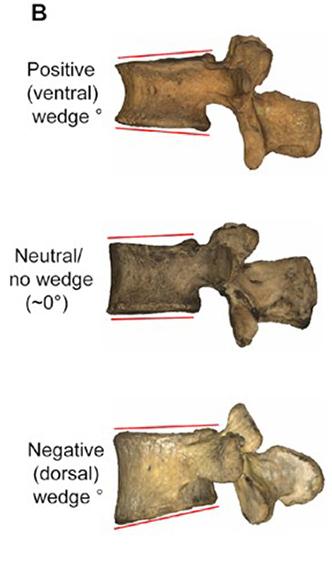 Anatomical illustration showing positive, neutral, and negative angles in vertebral bodies.