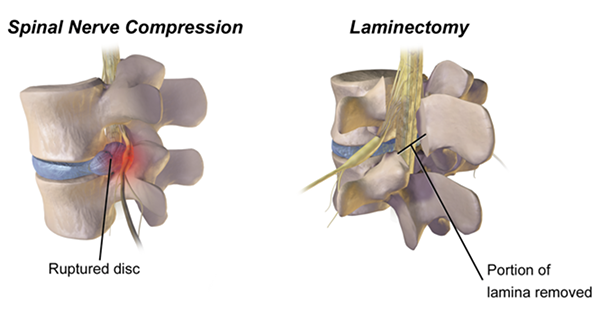 are pinched nerves same as bad vertebra in dogs