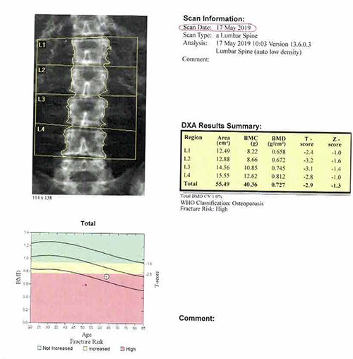 Dexa scan of lumbar spine, Fiona Nichols.