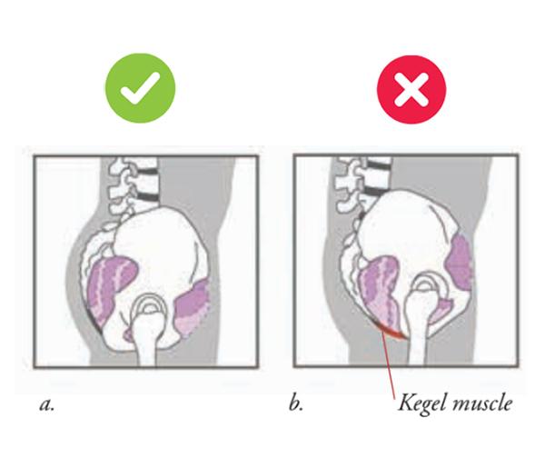  Two diagrams in profile showing anteverted and tucked pelvis effect on pelvic organs.