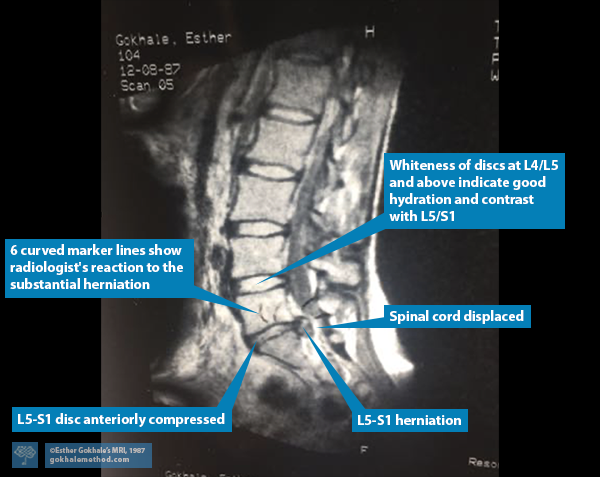 Esther Gokhale’s MRI 1987 showing herniation L5-S1.