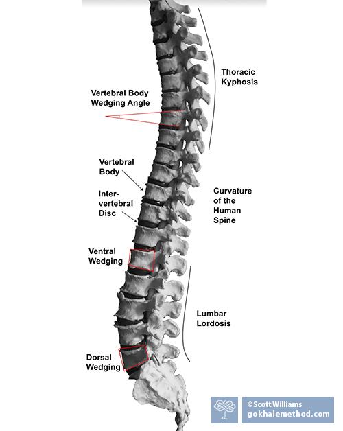 Medical illustration of J-shaped spine showing vertebral wedging and spinal curves.