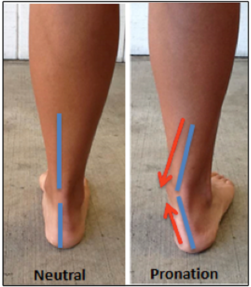 Photos of neutral foot and overpronated foot with lines on Achilles tendon.