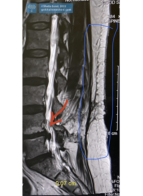 MRI 2022 of Sheila Bond’s lower back showing L4/L5 herniation and soft tissue damage.