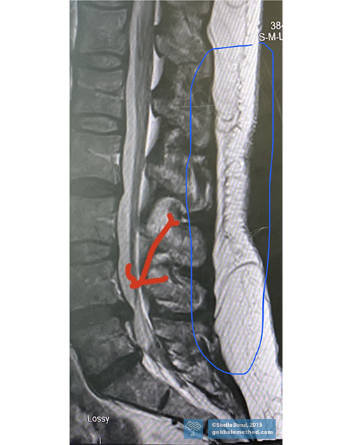 MRI 2015 of Sheila Bond’s lower back showing first L4/L5 herniation.