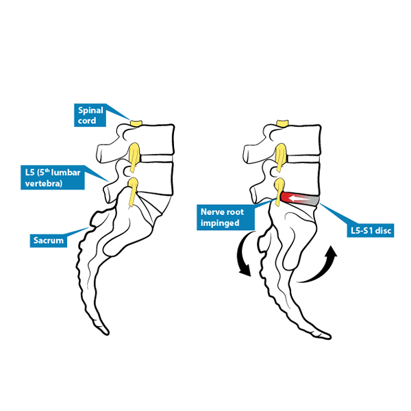 L5-S1 sacrum with nerves